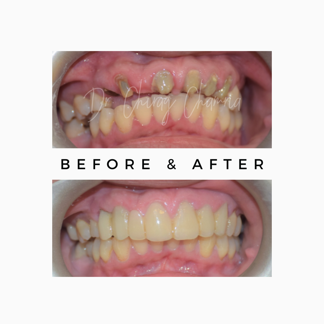 Full Mouth Smile Makeover